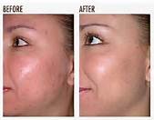 Acne Treatment